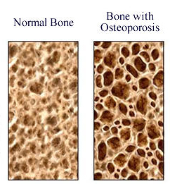 a study on osteoporosis a disease of the bones Osteoporosis is when the bones in our body become weak and brittle and can increase the risk of fractures osteoporosis linked to heart disease in elderly: study. a study on osteoporosis a disease of the bones Osteoporosis is when the bones in our body become weak and brittle and can increase the risk of fractures osteoporosis linked to heart disease in elderly: study.