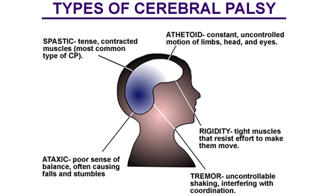 Studies Show Cannabis Effective Against Cerebral Palsy