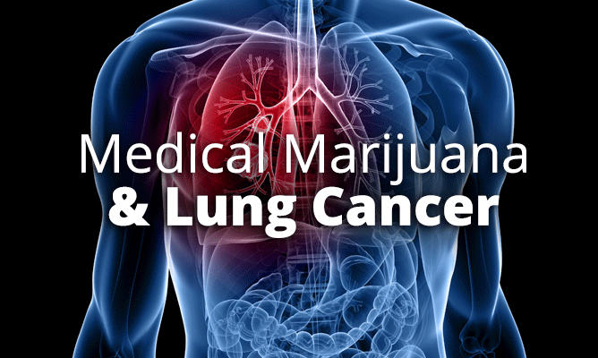 Cannabidiol (CBD) May Weaken Lung Cancer Cells