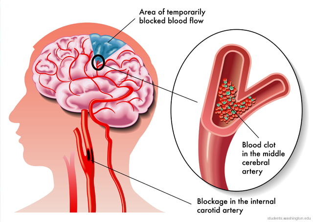 Brain damage during stroke may point to source of addiction