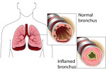 Studies Show Medical Marijuana May Help Asthma Patients