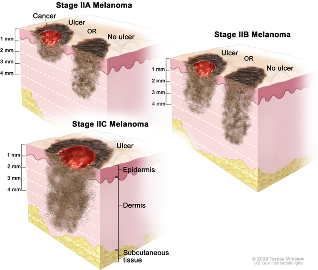 THC & CBD May Decrease Viability of Melanoma Cells